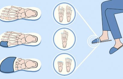 À la recherche de volontaires avec une amputation au pied